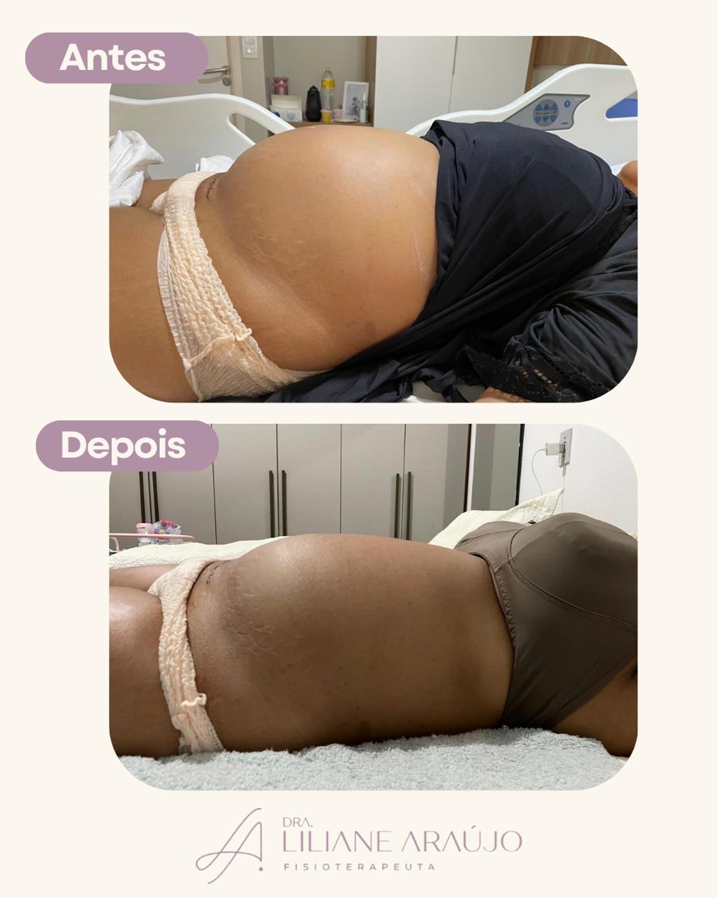 Antes e depois — taping compressivo pós-parto