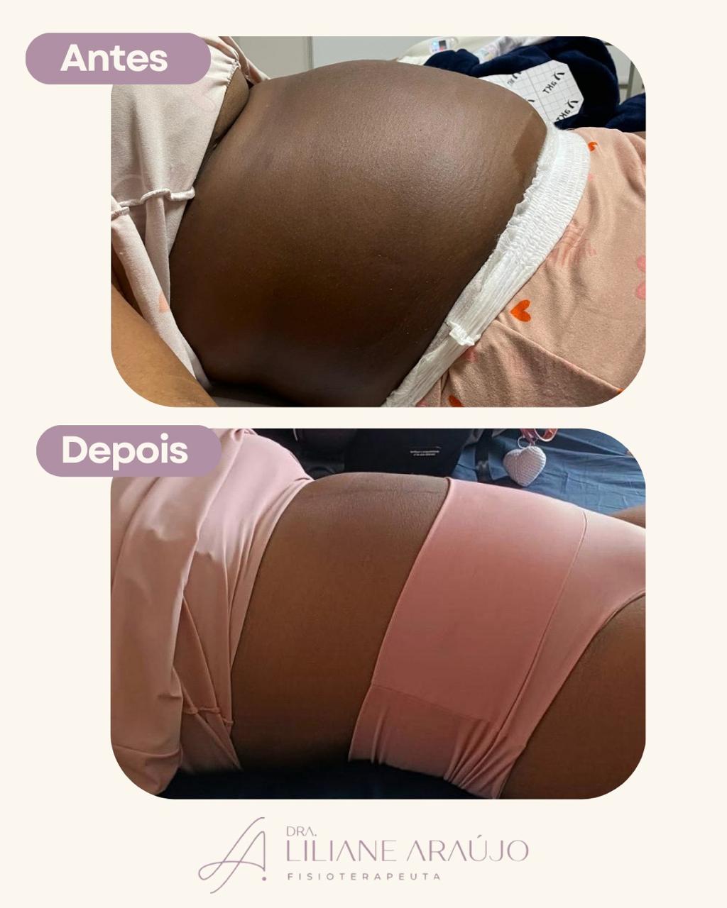 Antes e depois — taping compressivo pós-parto