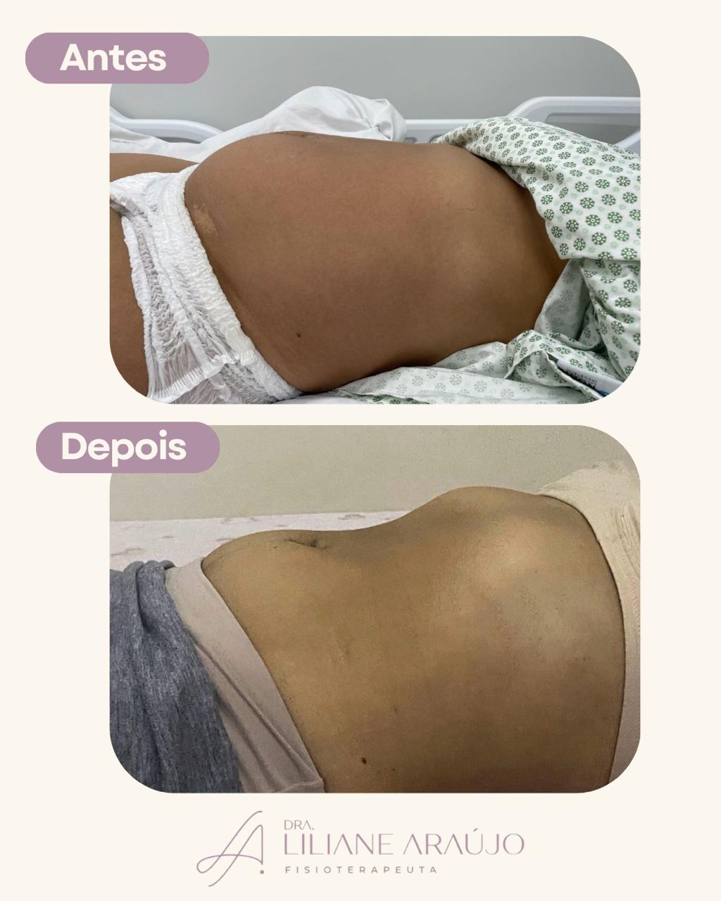 Antes e depois — taping pós-parto