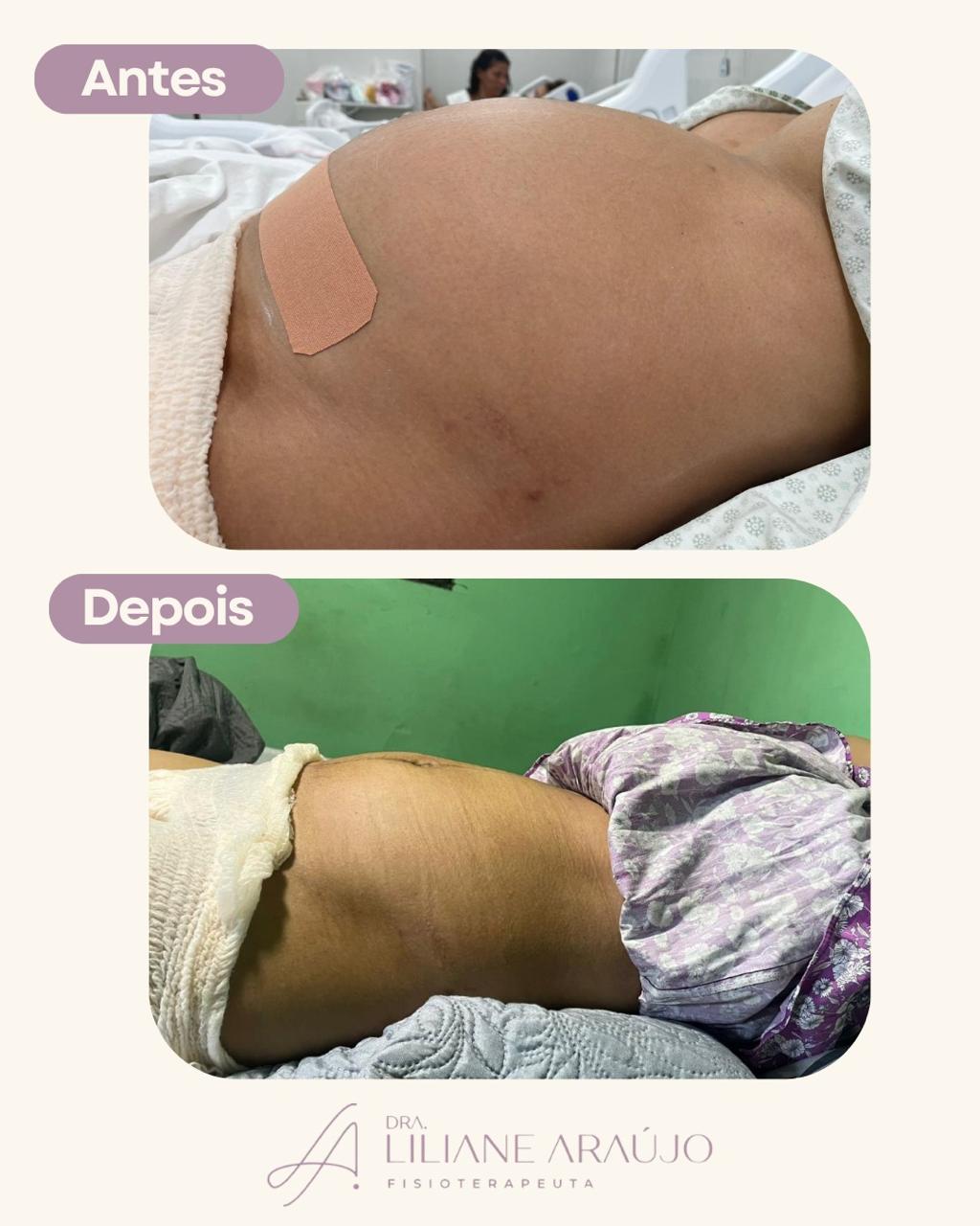 Antes e depois — taping pós-parto