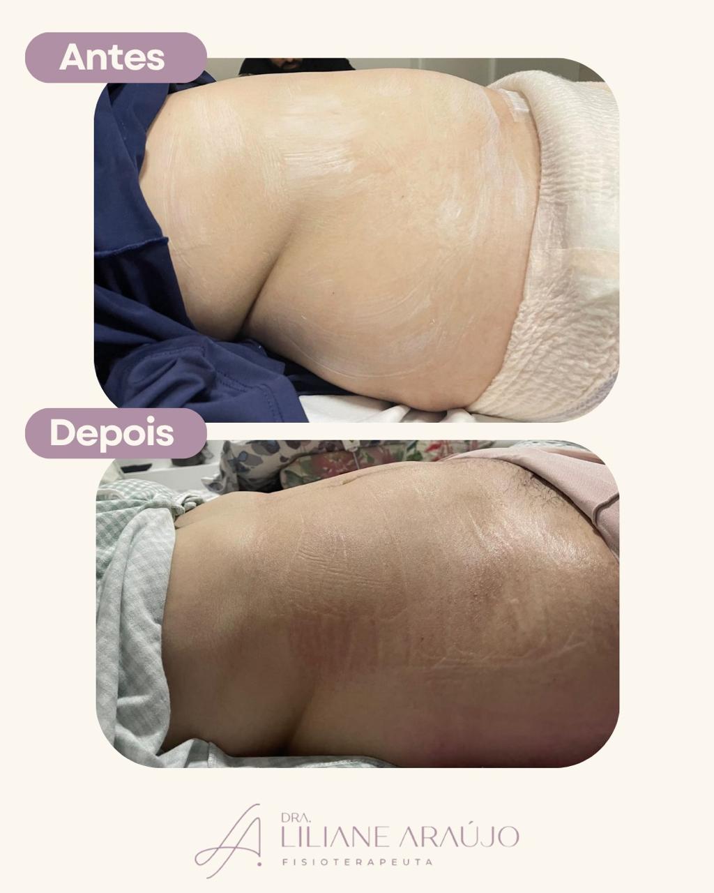 Antes e depois — taping compressivo