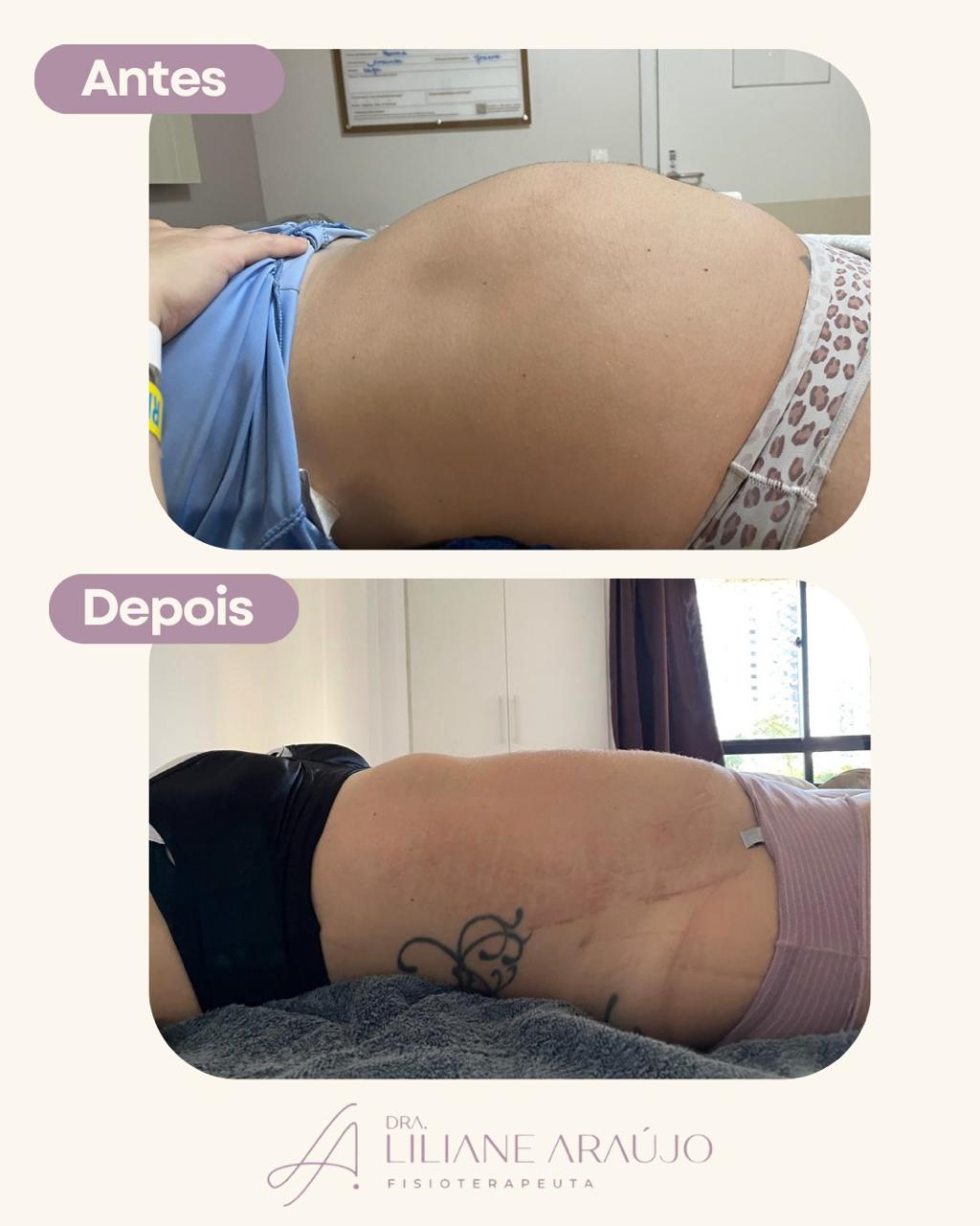Antes e depois — tape pós-parto