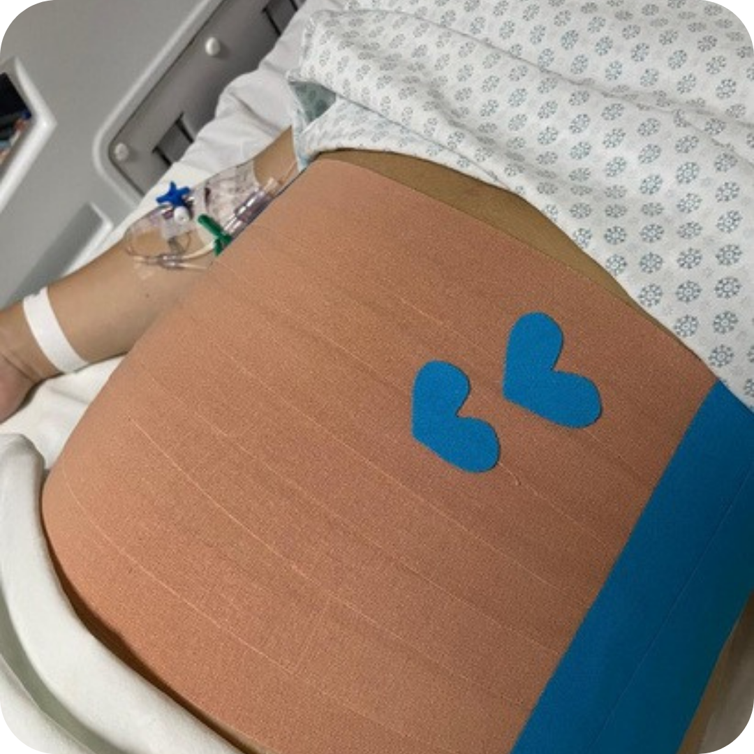 Fisioterapia pós-parto — taping e reabilitação